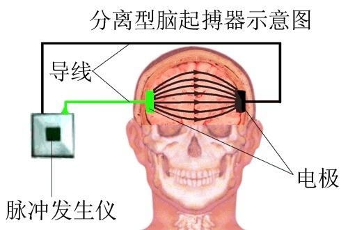 山東癲癇最新治療方法的研究與應(yīng)用進(jìn)展